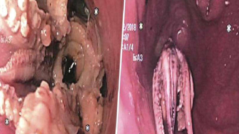 Kusma şikayetiyle doktora giden adamın boğazından ahtapot çıktı