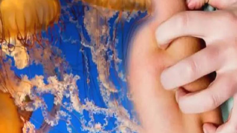 Tatilde başınıza gelebilir: Denizanası sokmasına ne iyi gelir?