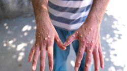 Maymun çiçeği salgını: Dünya Sağlık Örgütü, küresel acil durum ilan etti